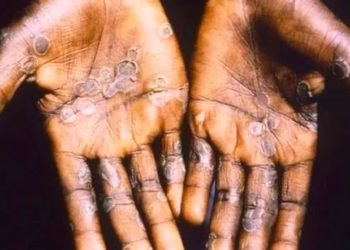 Pasien yang terkena virus cacar monyet.(Foto: CDC Public Health Image Library) (ant)