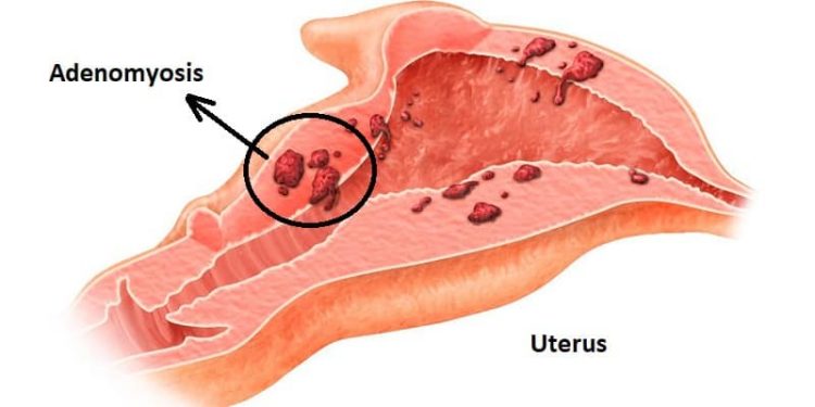 Adenomiosis dan Kesuburan. GOOGLE