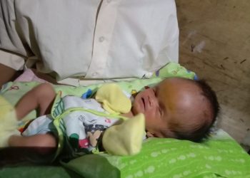 ULURAN DERMAWAN. Diah Ajeng Kartika Rahayu, bayi yang menderita hidrosefalus, membutuhkan uluran tangan para dermawan. LAMPUNG POST/YON FISOMA