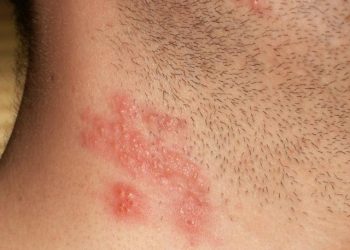 Penyakit Herpes. (DOK)