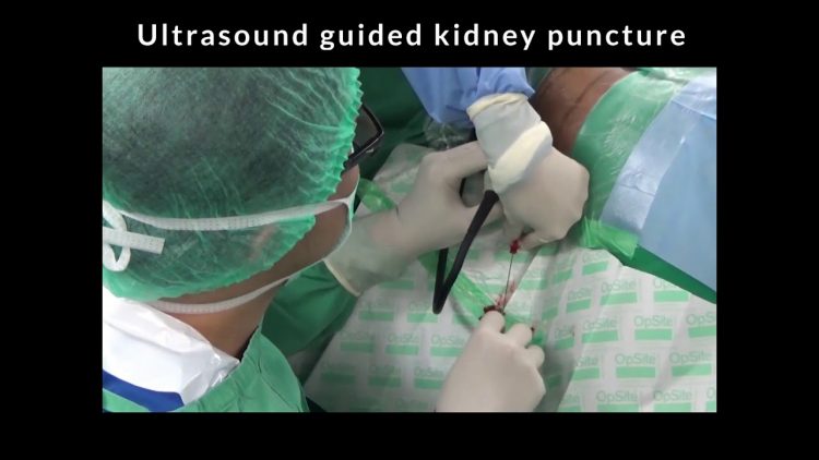 Kemenkes temukan kasus baru gagal ginjal akut di Indonesia. (DOK.MI)