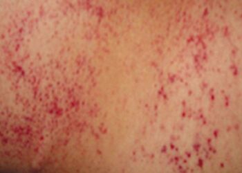 Ruam menjadi gejala kanker darah atau leukimia. (DOK)