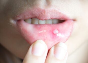 Sariawan juga menjadi tanda dari Covid-19. (DOK)