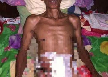 Penderita Infeksi Usus di Sungai Badak Mesuji Butuh Perhatian Pemerintah