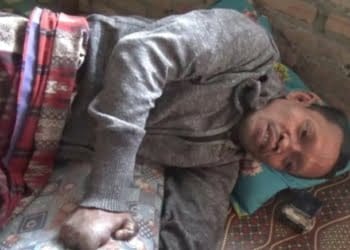 penderita Kusta di Pekon Sampang Turus Tanggamus Butuh Perhatian Pemerintah