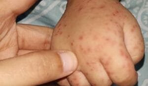 Waspadai Flu Singapura, Kenali Gejala, Sebaran, dan Pencegahannya
