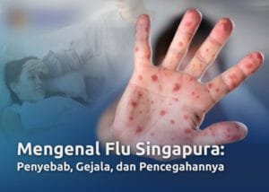 Dinkes Pesawaran Konfirmasi 4 Kasus Flu Singapura
