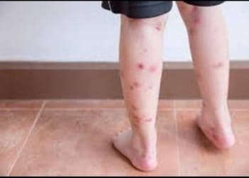 Ilustrasi flu Singapura. Dok Medcom.