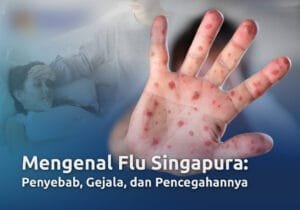 Kenali Gejala Flu Singapura, Terapkan Pola Hidup Sehat untuk Mencegahnya