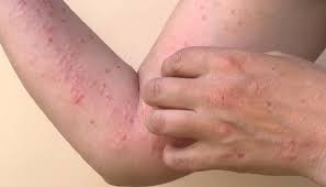 Pemerintah Provinsi DKI Jakarta melaporkan bahwa terdapat 59 kasus terkonfirmasi cacar monyet