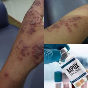 Varian Cacar Monyet (Mpox) Mematikan Terdeteksi Pertama di Amerika Serikat