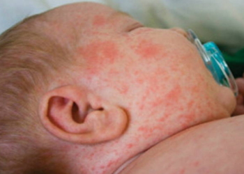 Ilustrasi campak pada anak.