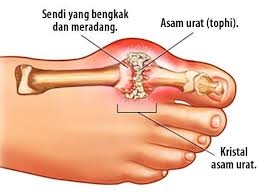 Asam urat yang membuat nyeri di persendian