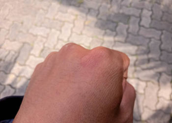 Sering Terkena Sinar Matahari Sebabkan Munculnya Flek Hitam di Tangan